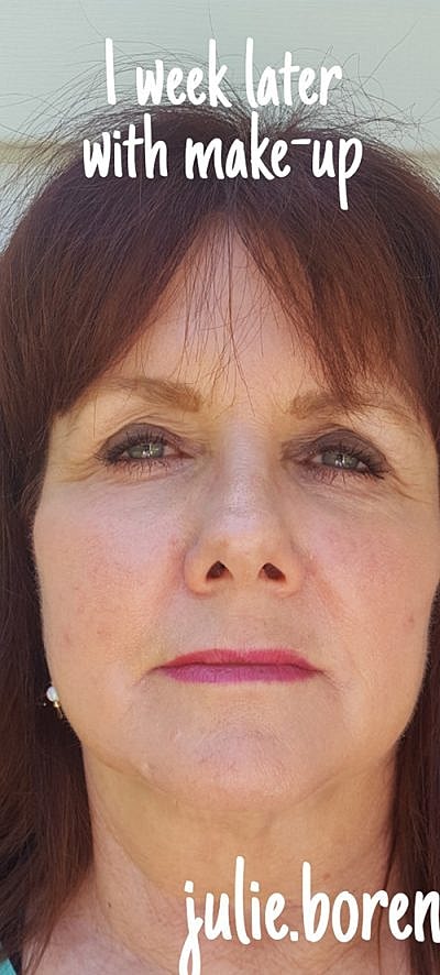 Cheek Fillerzz Before & After