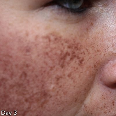 Cheek Fillerzz Before & After