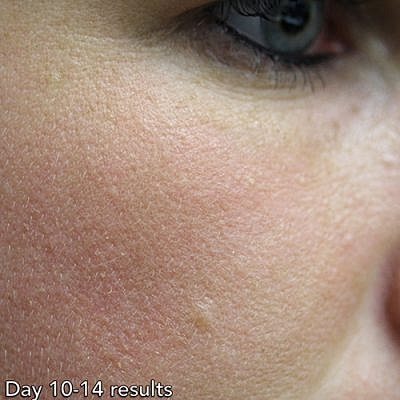 Cheek Fillerzz Before & After