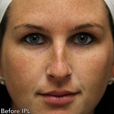 Cheek Fillerzz Before & After