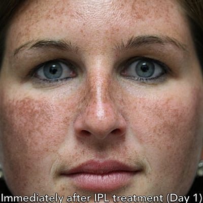 Cheek Fillerzz Before & After