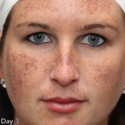 Cheek Fillerzz Before & After