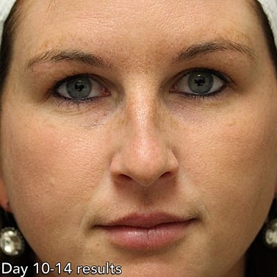 Cheek Fillerzz Before & After