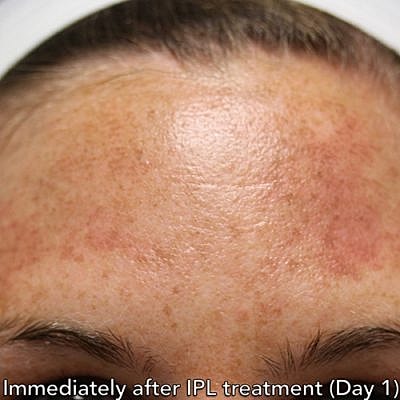 Cheek Fillerzz Before & After