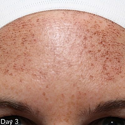 Cheek Fillerzz Before & After