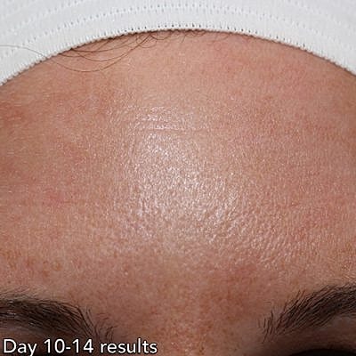 Cheek Fillerzz Before & After