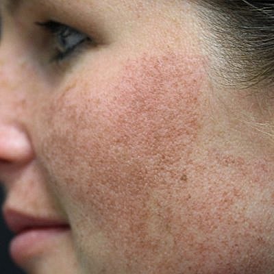 Cheek Fillerzz Before & After