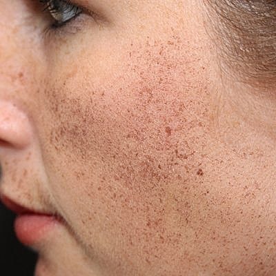 Cheek Fillerzz Before & After