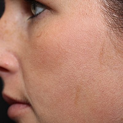 Cheek Fillerzz Before & After