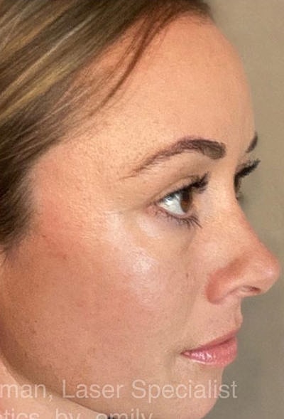 Cheek Fillerzz Before & After