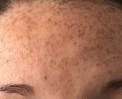 Cheek Fillerzz Before & After