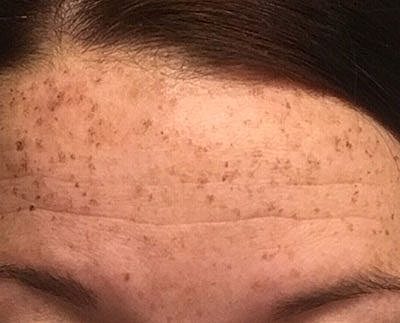 Cheek Fillerzz Before & After