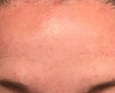 Cheek Fillerzz Before & After