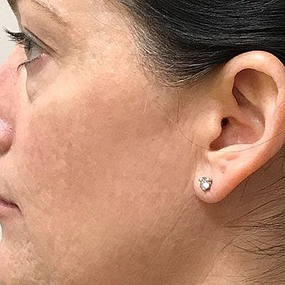 Cheek Fillerzz Before & After