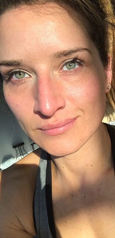 Cheek Fillerzz Before & After