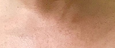 Cheek Fillerzz Before & After