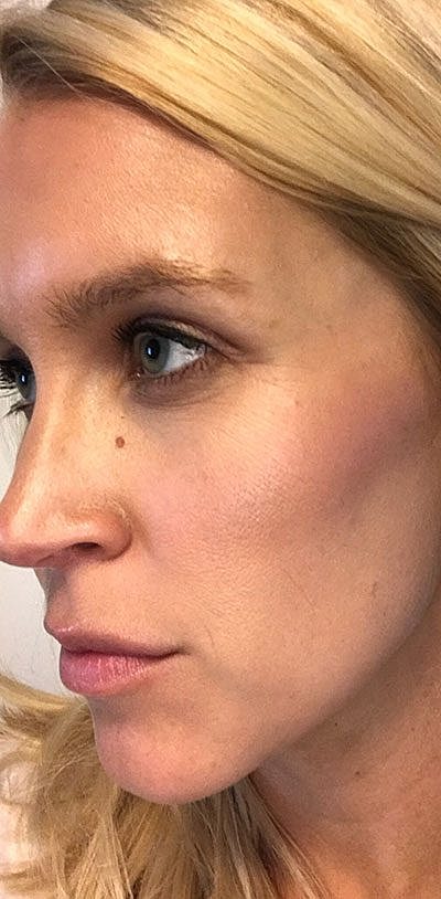 Cheek Fillerzz Before & After