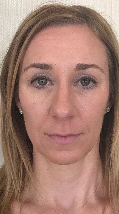 Cheek Fillerzz Before & After