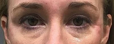 Cheek Fillerzz Before & After