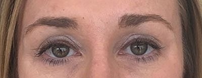 Cheek Fillerzz Before & After