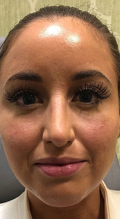 Cheek Fillerzz Before & After