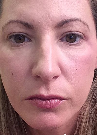 Cheek Fillerzz Before & After