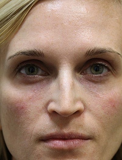 Cheek Fillerzz Before & After