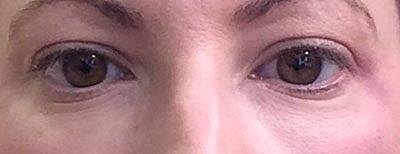 Cheek Fillerzz Before & After