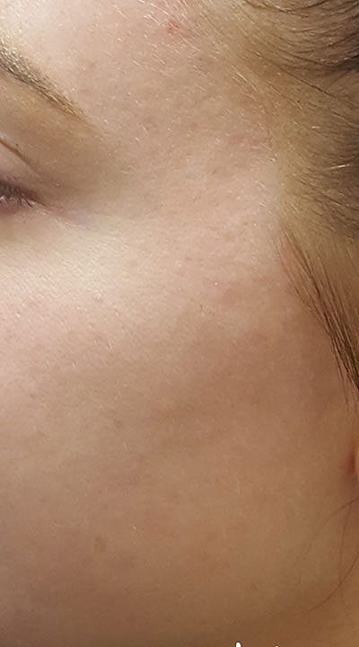 Cheek Fillerzz Before & After