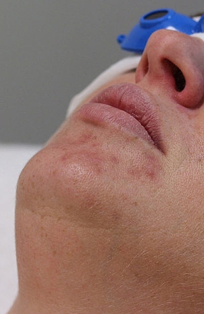 Cheek Fillerzz Before & After