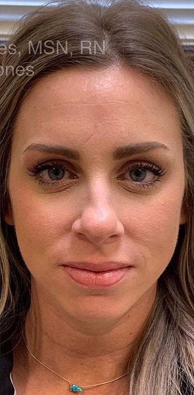 Cheek Fillerzz Before & After