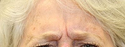 Cheek Fillerzz Before & After