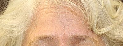 Cheek Fillerzz Before & After