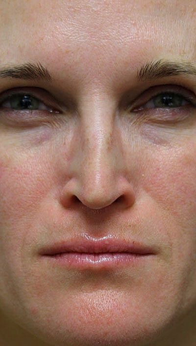 Cheek Fillerzz Before & After