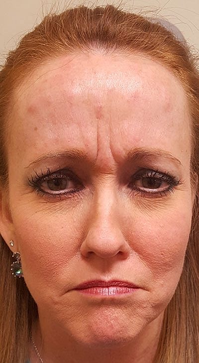 Cheek Fillerzz Before & After