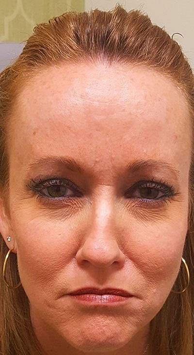 Cheek Fillerzz Before & After