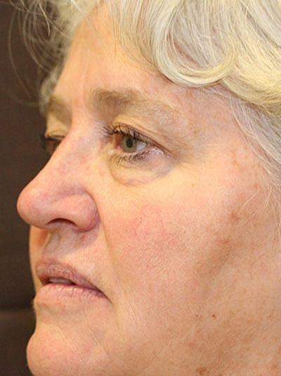 Cheek Fillerzz Before & After