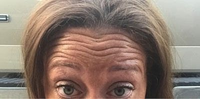 Cheek Fillerzz Before & After