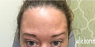 Cheek Fillerzz Before & After