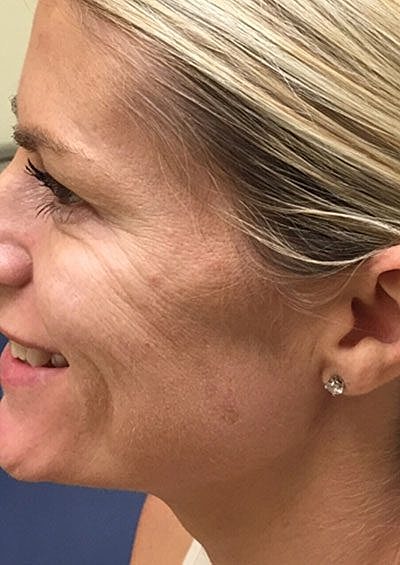 Cheek Fillerzz Before & After