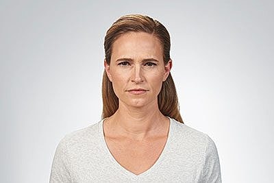 Cheek Fillerzz Before & After