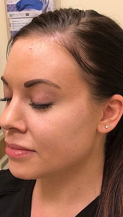 Cheek Fillerzz Before & After