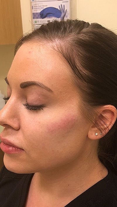 Cheek Fillerzz Before & After