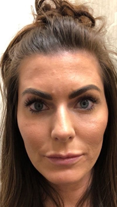 Cheek Fillerzz Before & After